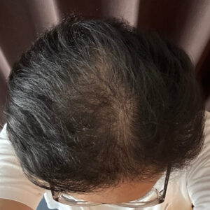 薄毛改善の検証実験開始より10ヶ月経過後　頭頂部状態　画像